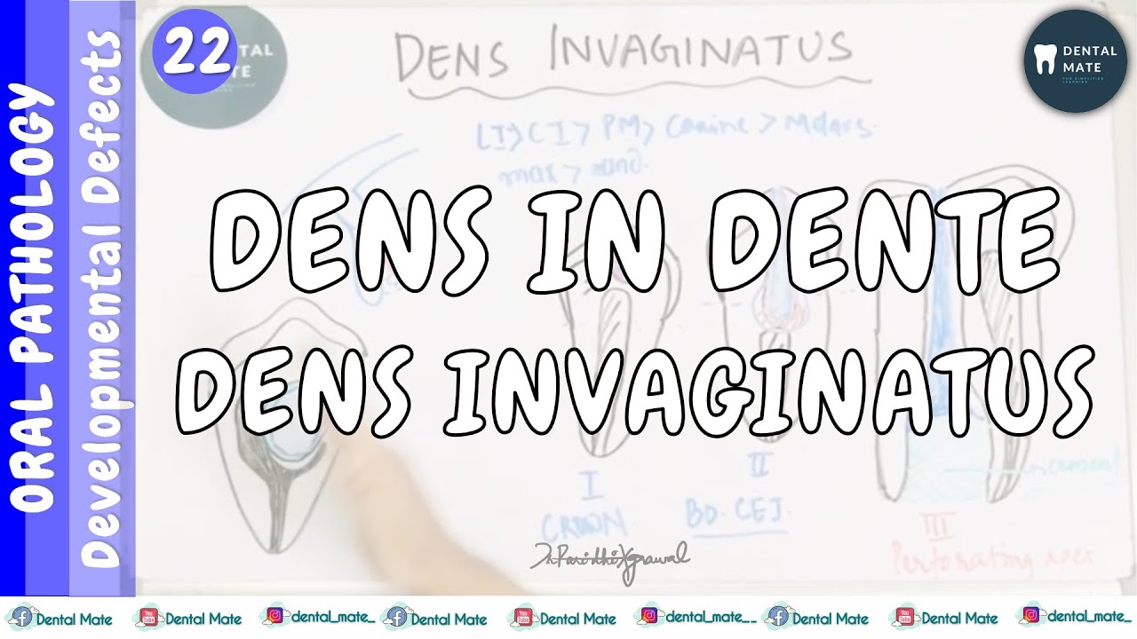 Dens invaginatus | Dens in dente | Расширенный одонтом | Нарушения развития зубов | Доктор Паридх...