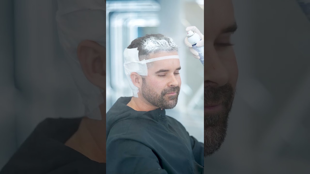 Unshaven Hair Transplantation Technique