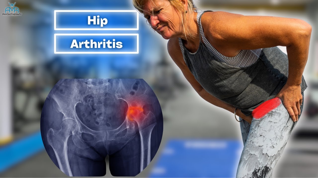 Beat Hip Osteoarthritis Pain: BEST Exercises and Treatment Insights!