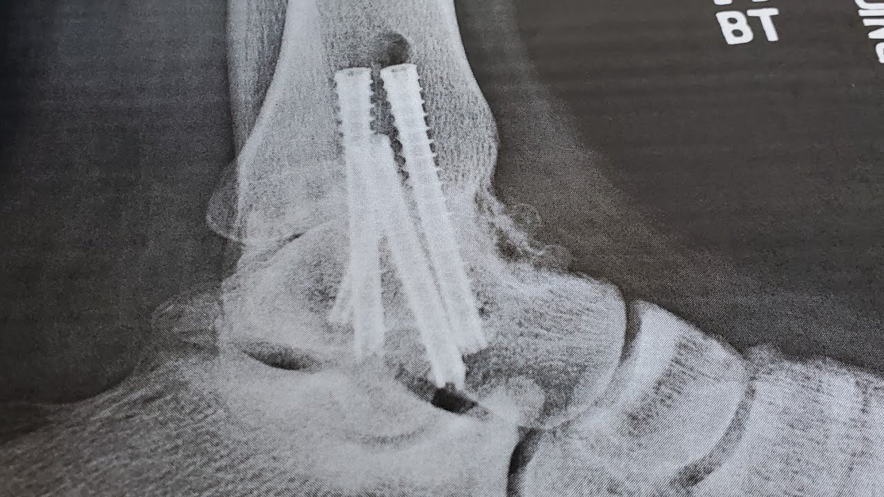 6-24-23 Ankle Fusion 6