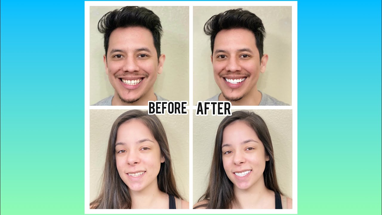 WE TRIED SHINY SMILE SNAP ON VENEERS! Review + Update
