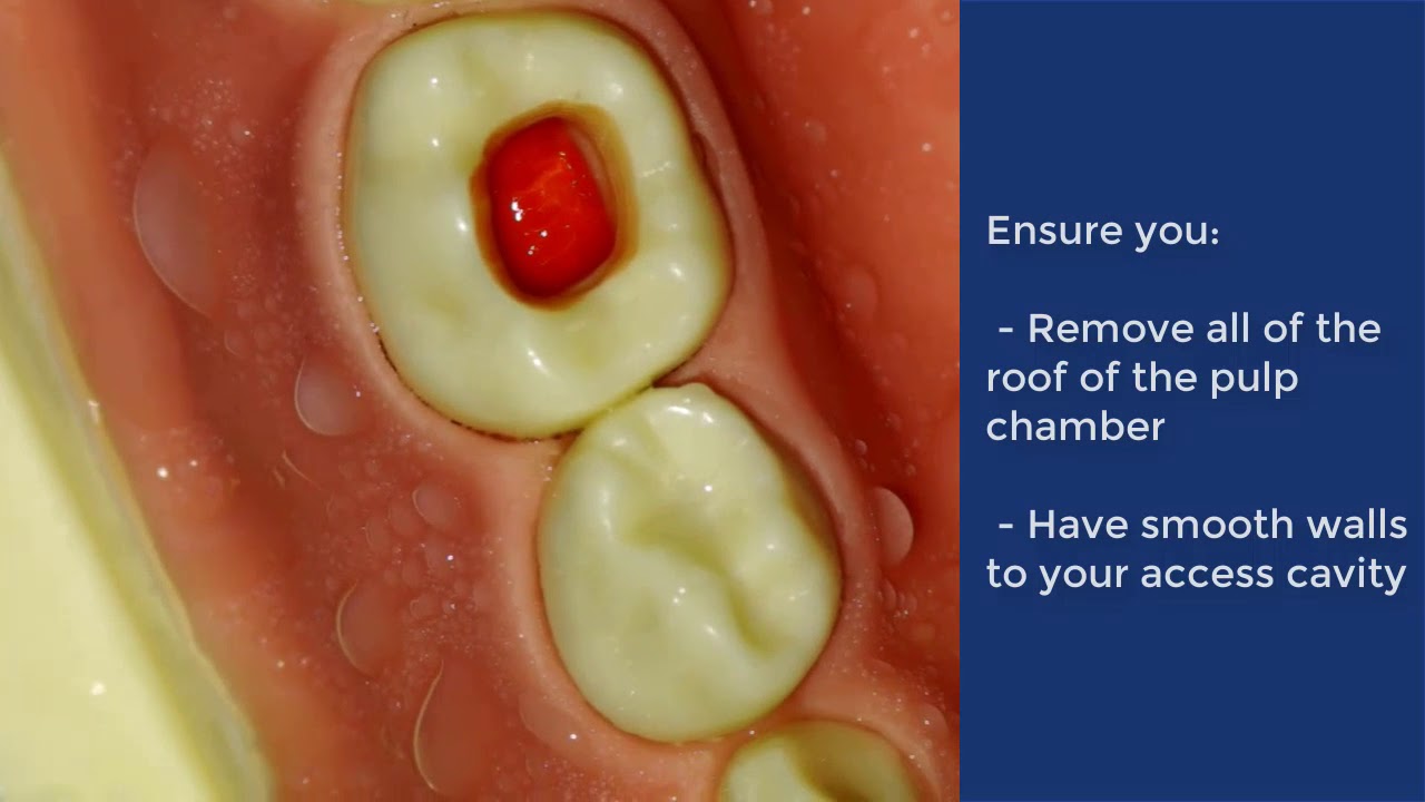 Pulpotomy of Deciduous Molar - QMUL
