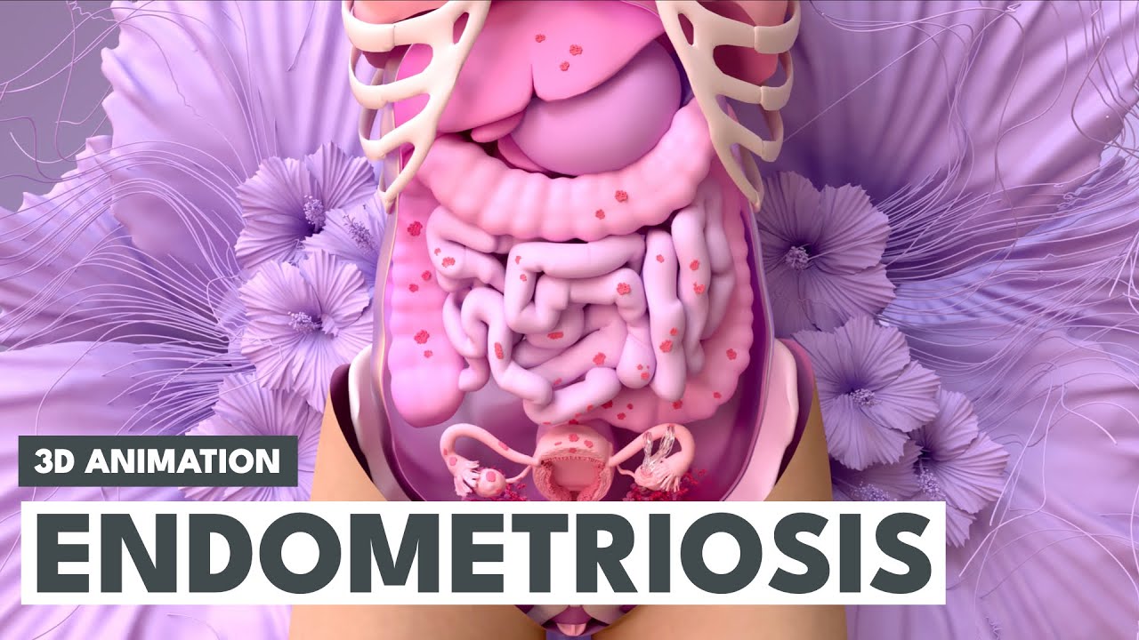 Endometrioza | Animacja 3D