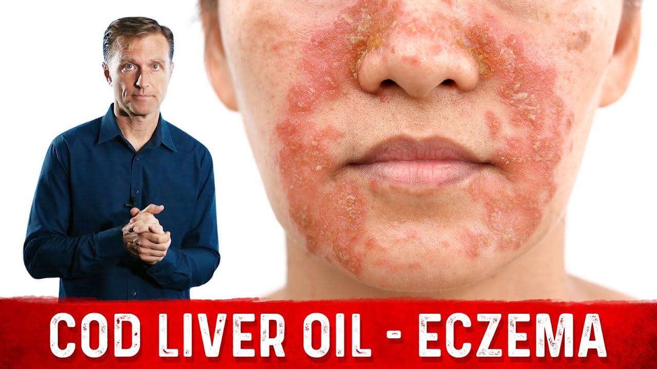 Why Use Cod Liver Oil for Eczema? Remedies for Eczema &ndash; Dr. Berg