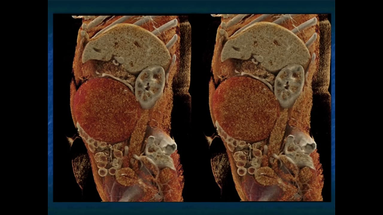 Desmoid Tumor of the Mesentery: A Potential Mimic of Other GI Pathology