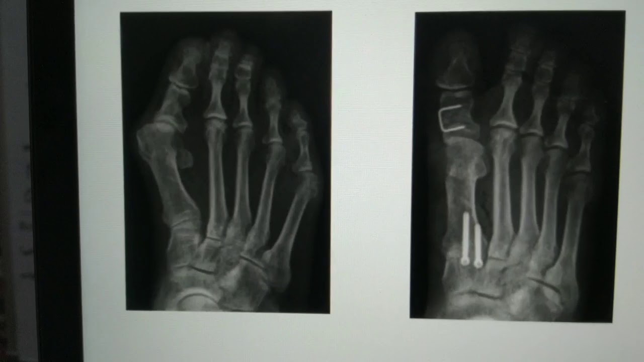 50: Hallux Valgus: Part 2; Osteotomies