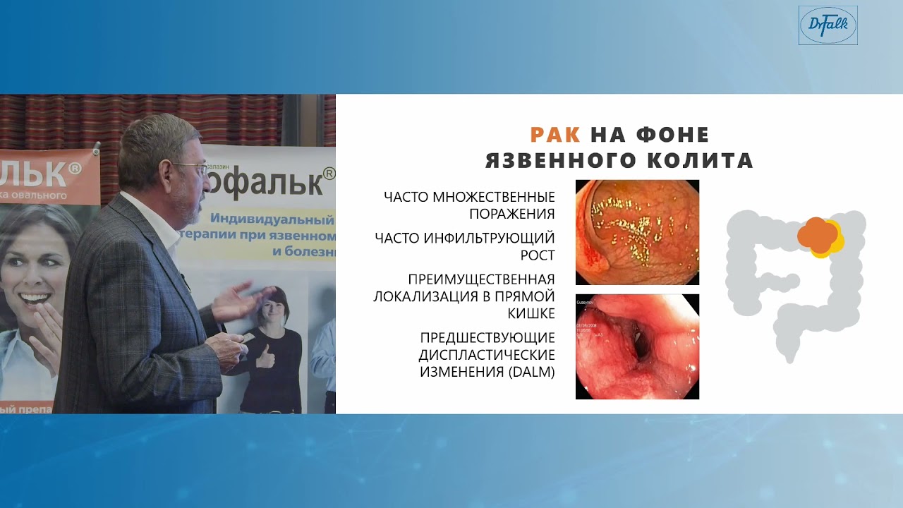 Головенко О.В. &laquo;Можно ли прогнозировать течение ВЗК у нашего пациента?&raquo;