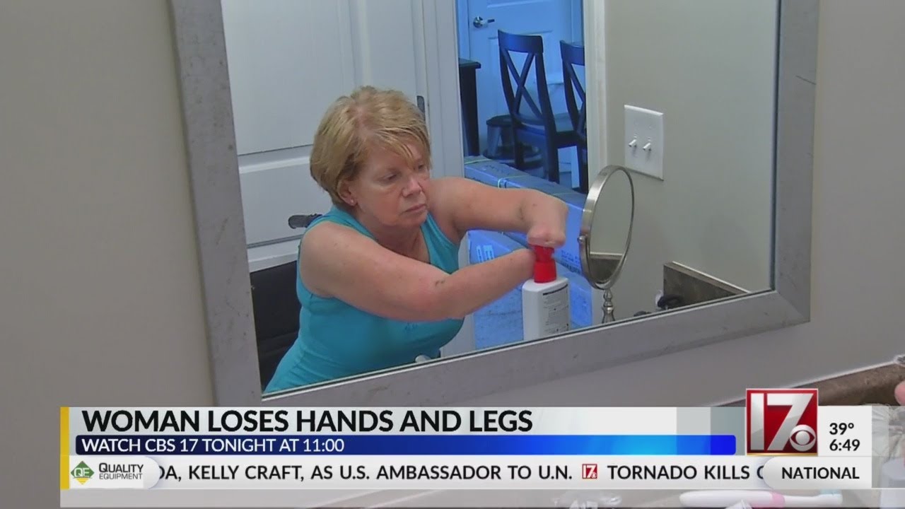 Woman who lost hands, legs undergoes life-changing surgery