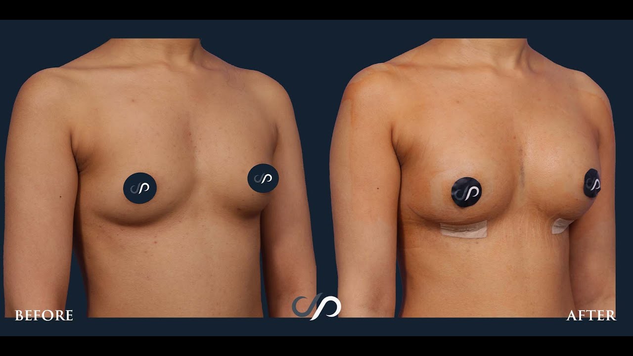 L.A. Natural Breast Augmentation | Dr. David Stoker | Los Angeles, CA