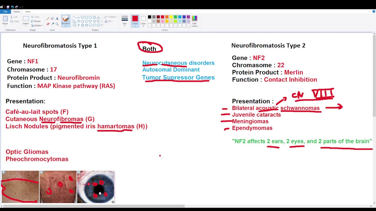 Neurofibromatosis Types 1 and 2