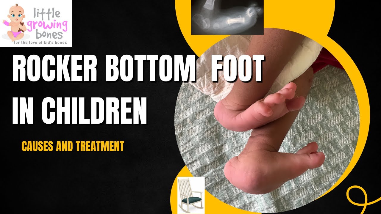 Rocker Bottom Feet in children : The Rare foot deformity ad its treatment