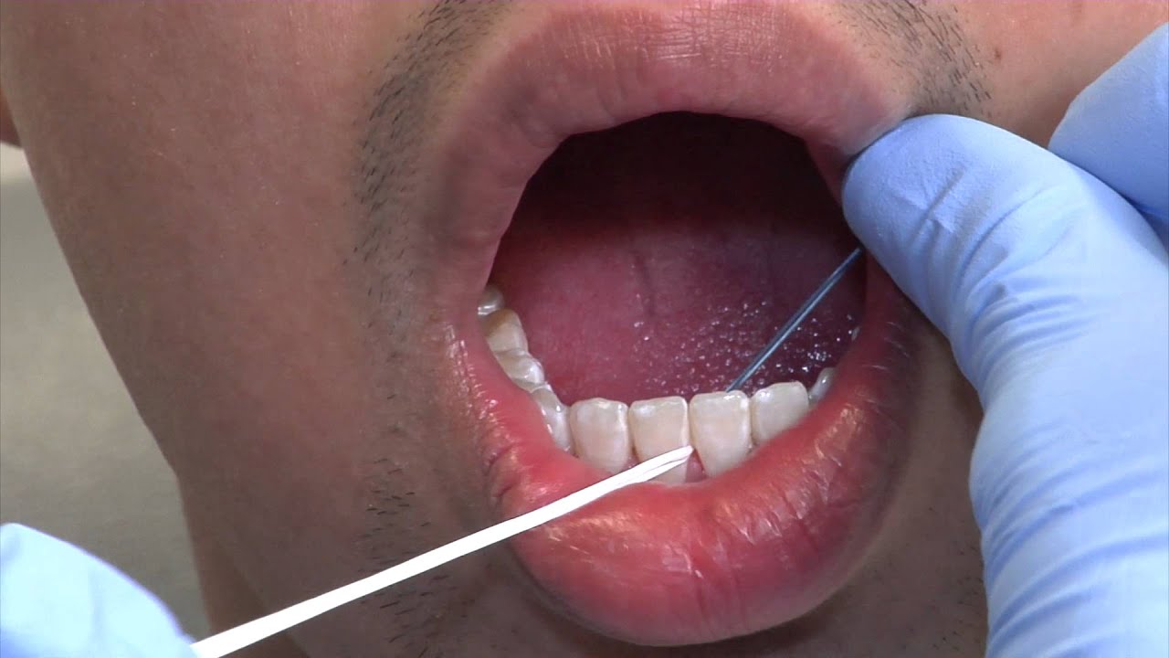 Debond - Part3: Retainer Care