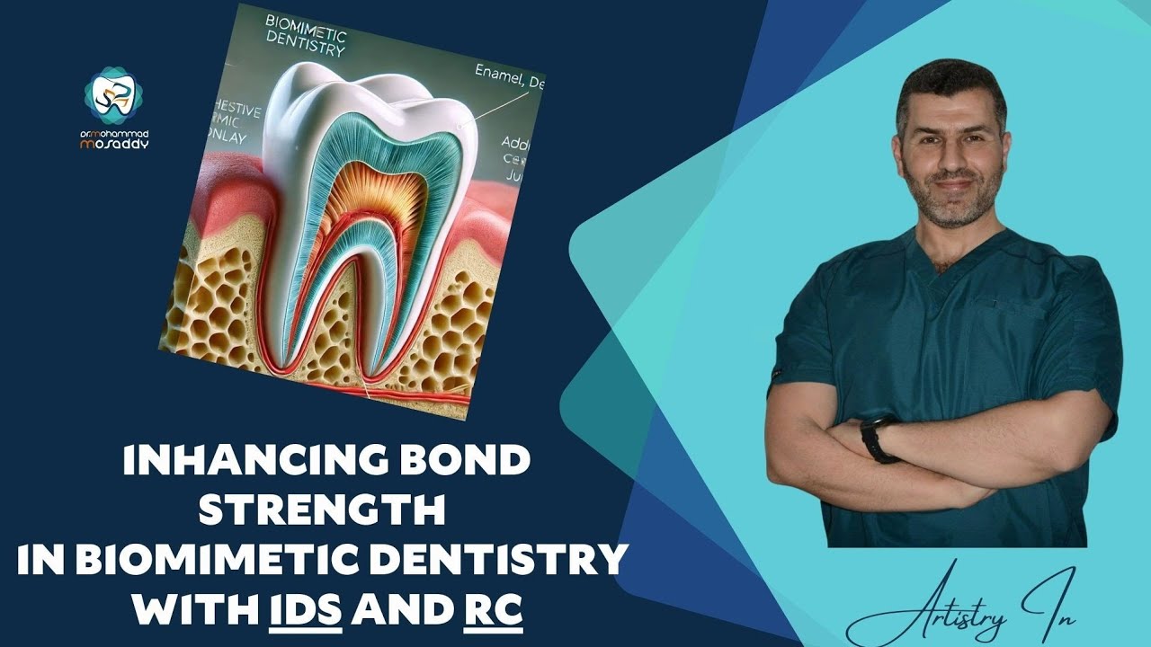 Immediate Dentin Seal IDS