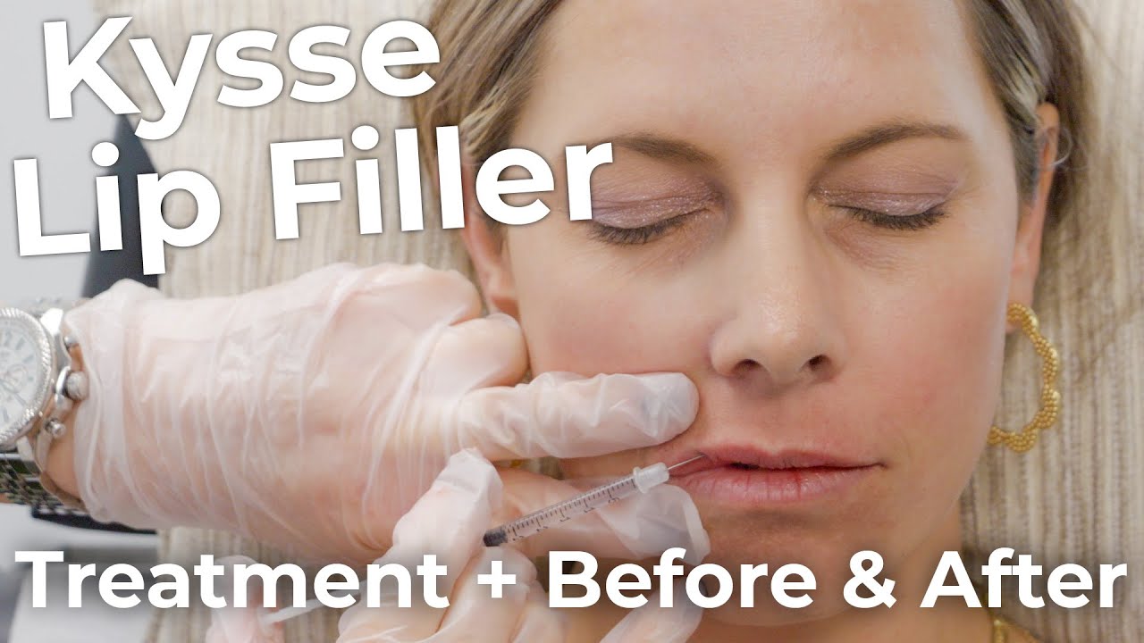 Lip Filler Treatment with Before & After