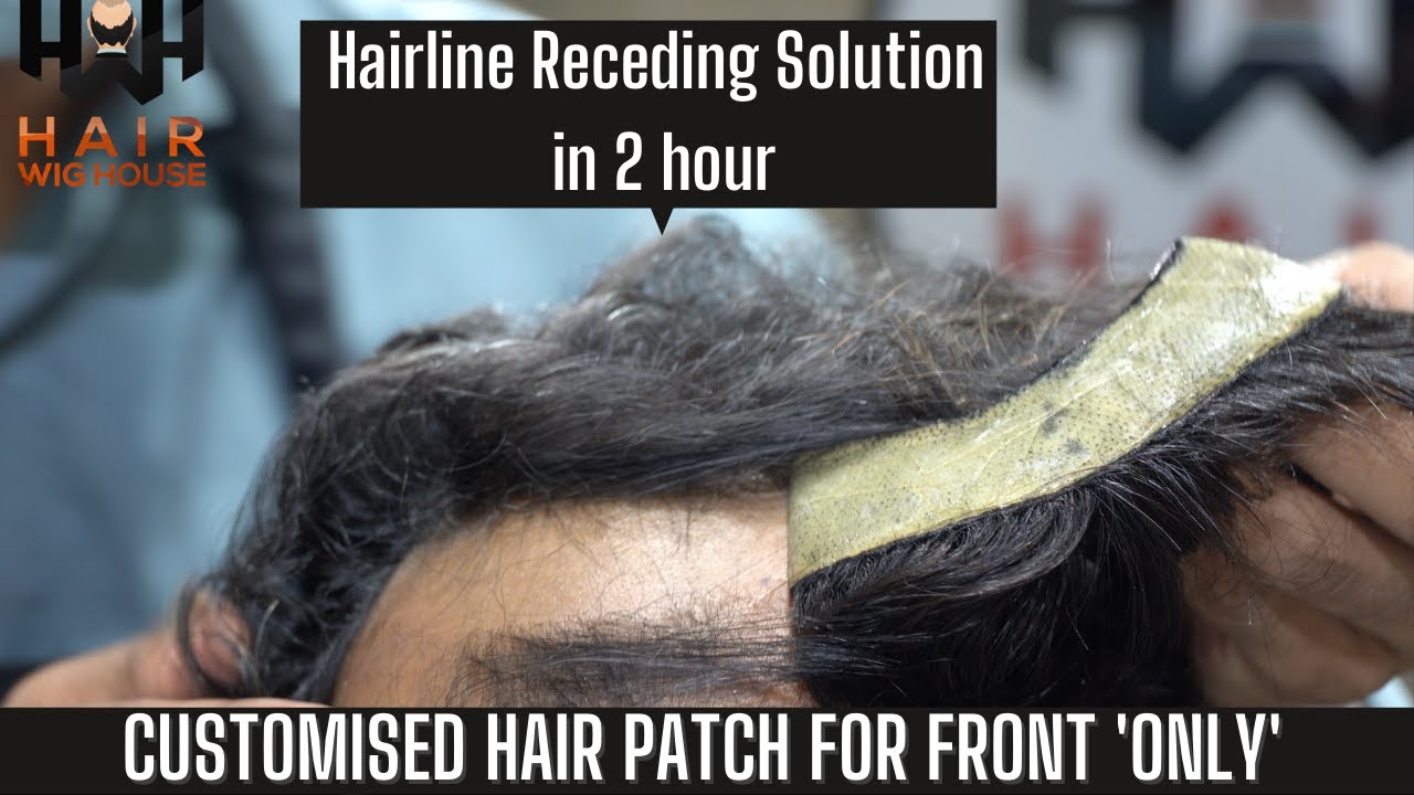Customised Hairline Patch / हेयर लाइन पैच For Front | Hair Receding | Customer Review | 9953384242