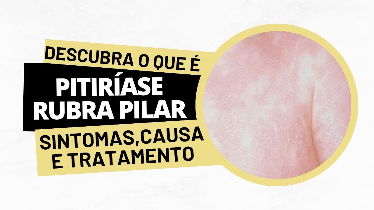 Pitiríase rubra pilar - Sintomas, causa e tratamento