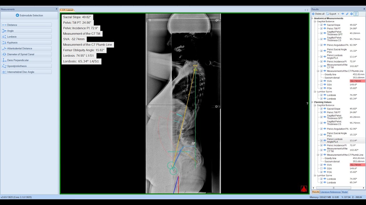 Spine 3D - Sagittal Balance