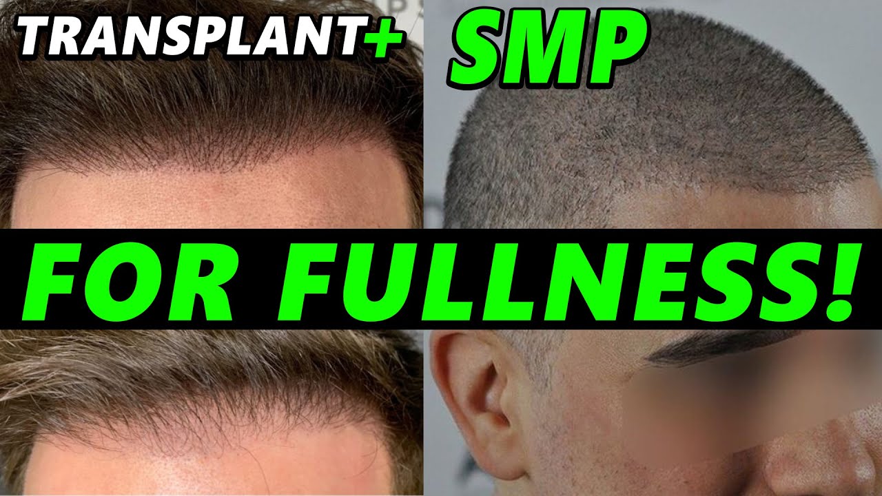 Hair Transplant Enhancement with SMP - 3 Ideal Cases To Do It! Scalp Micropigmentation