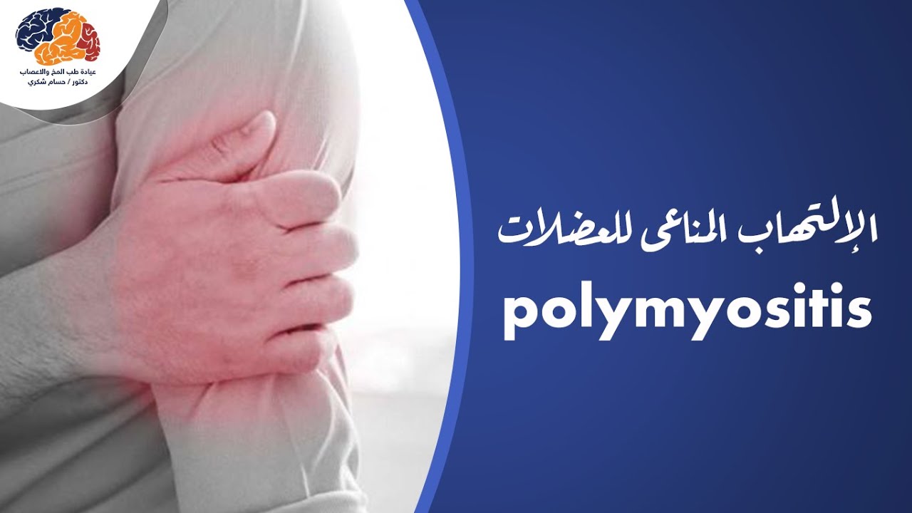الإلتهاب المناعى للعضلات   #polymyositis
