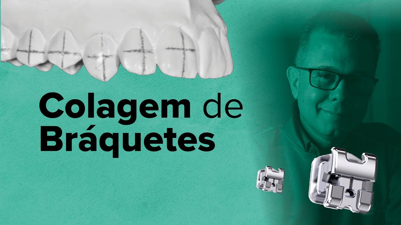 COLAGEM DE BRÁQUETES PASSO A PASSO E COMPARAÇÃO DE RESINAS PARA NÃO FICAR SOLTANDO - LIVE 14/09/2021