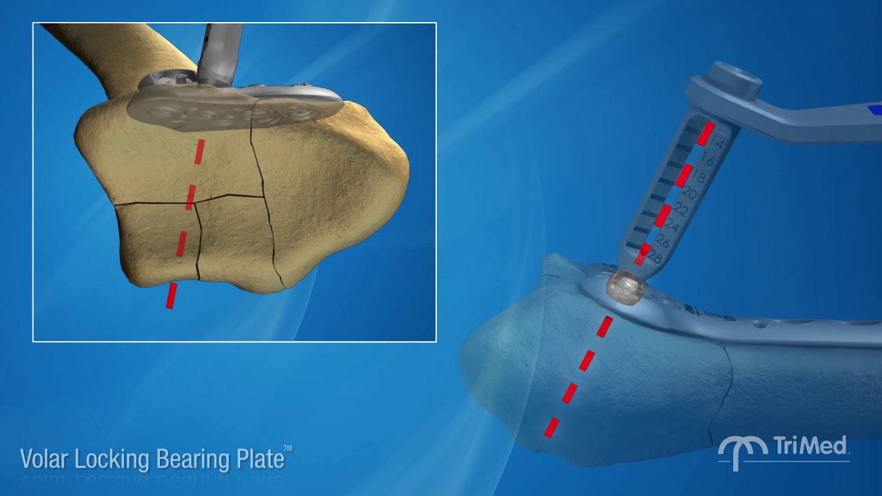 It's a volar plate....And so much more!