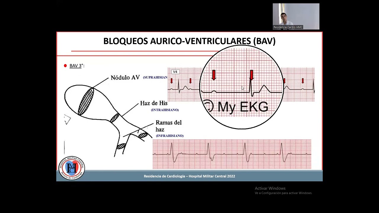 BRADIRRITMIAS - Manejo básico del paciente con patología cardiovascular