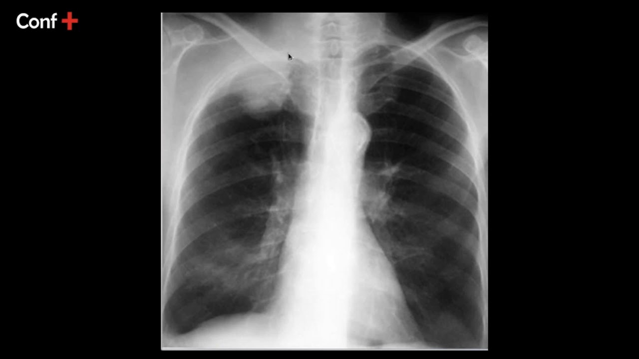 Cas d'imagerie (tumeur pulmonaire)