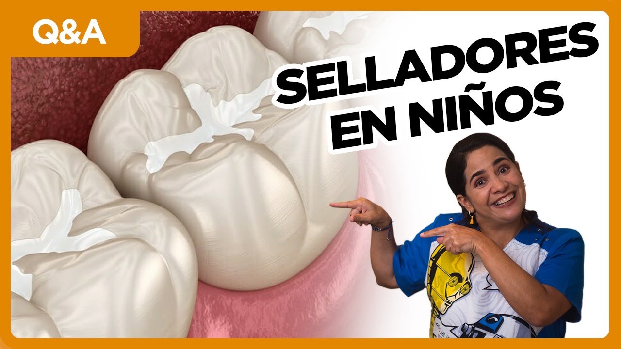 Selladores o sellantes: todo lo que necesitas saber