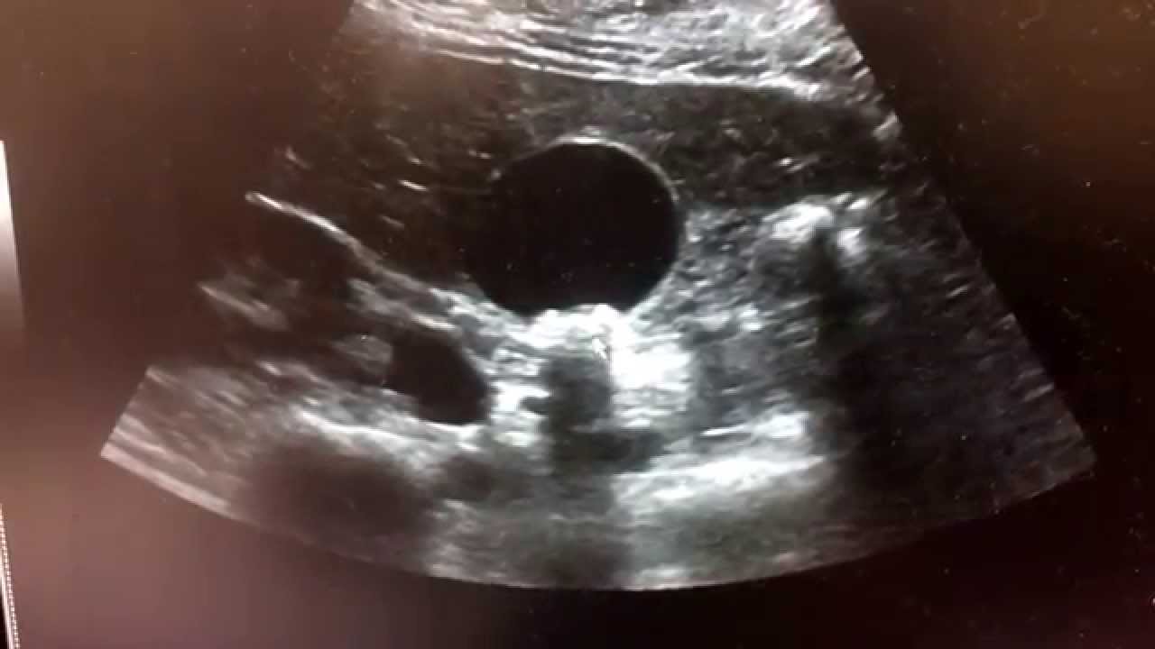 Gallstones in ultrasound