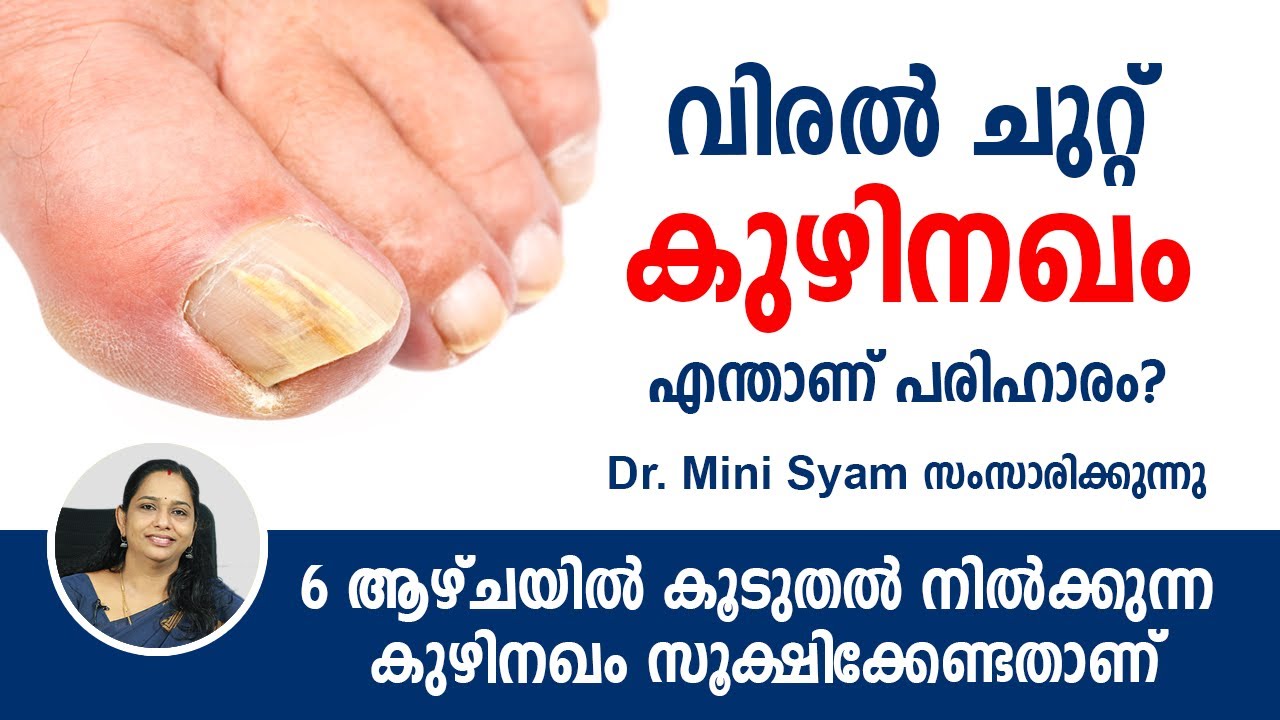 കുഴിനഖം - വിരൽ ചുറ്റ്  | 6 ആഴ്ചയിൽ കൂടുതൽ നിൽക്കുന്ന കുഴിനഖം സൂക്ഷിക്കേണ്ടതാണ് Fungal Nail Infection