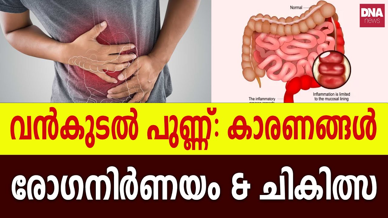 വൻകുടൽ : രോഗനിർണയം മുതൽ ചികിത്സ വരെ | dnanewsmalayalam