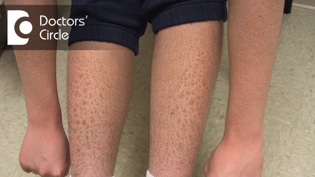 How to manage Ichthyosis Vulgaris in teenage boys? - Dr. Nischal K