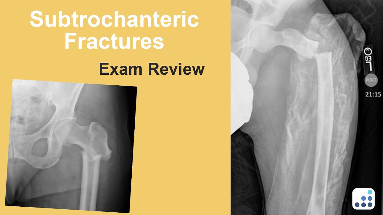 Subtrochanteric Fractures Exam Review - Bohannon Mason, MD