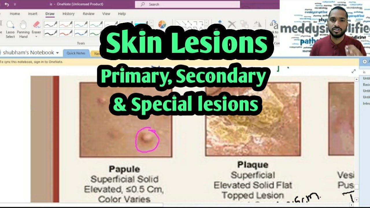 Skin lesions | Primary and Secondary Skin lesions |Target lesion | Burrows