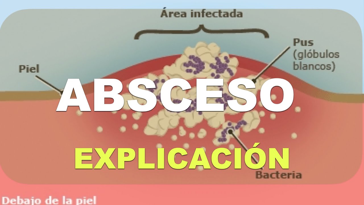 Qu&eacute; es un absceso y c&oacute;mo se forma