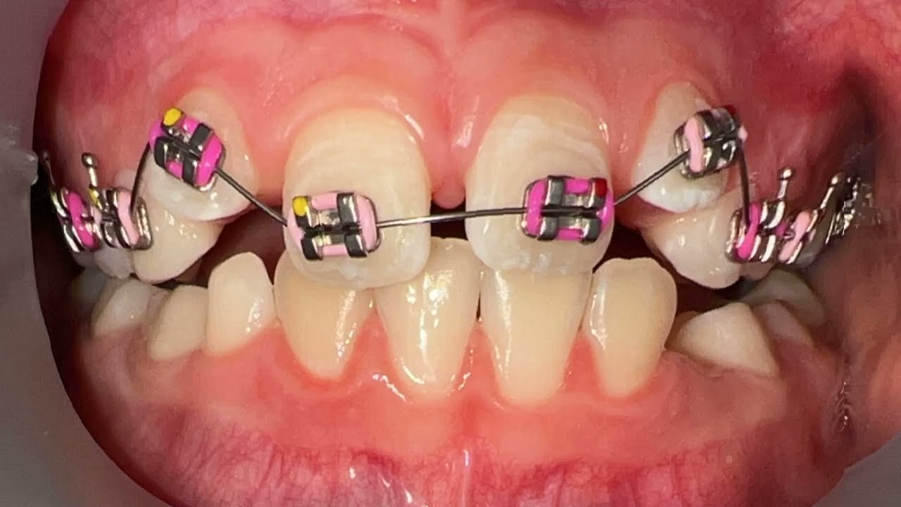 Smile Transformation Tuesday 05.20.25