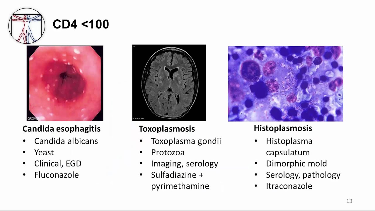 HIV: Clinical Disease and Opportunistic Infections