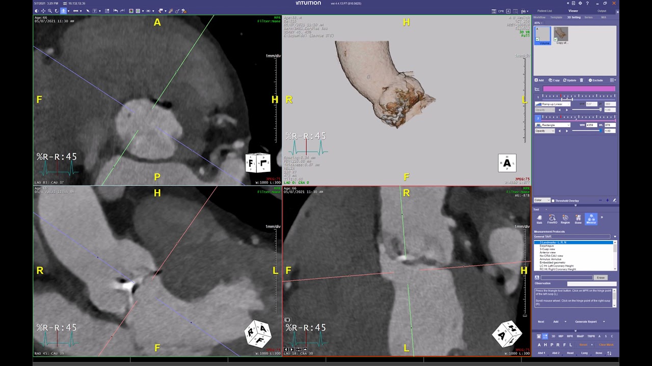 Cusp Overlap view for TAVR.  Manual workflow.  Intuition from Terarecon