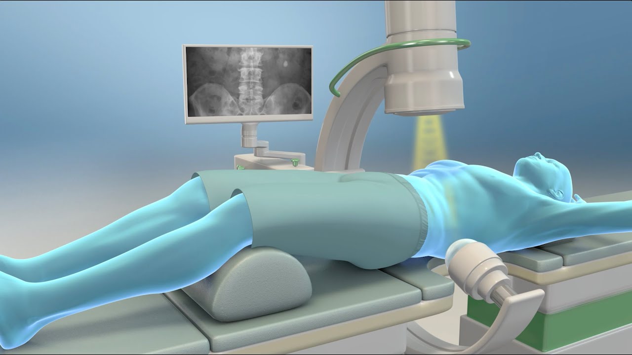 Extracorporeal Shock Wave Lithotripsy (ESWL)