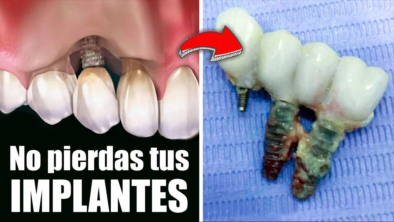 Cómo CUIDAR tus CORONAS y PRÓTESIS sobre IMPLANTES dentales 🦷 Dr YURI MARTINEZ 💋 Prodent Perú