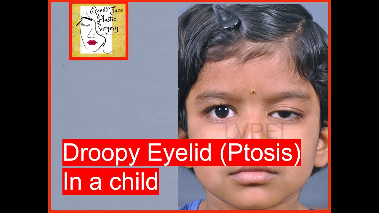 Droopy eyelid (Ptosis) in a child