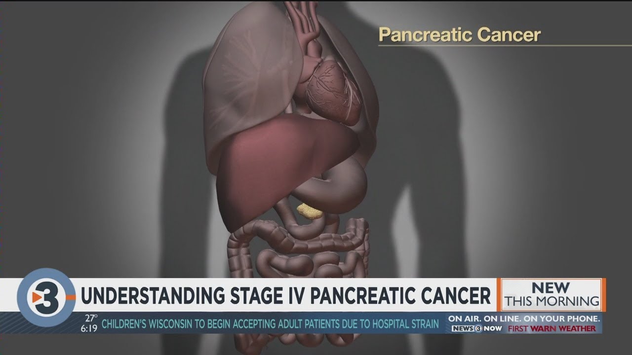 Understanding stage IV pancreatic cancer