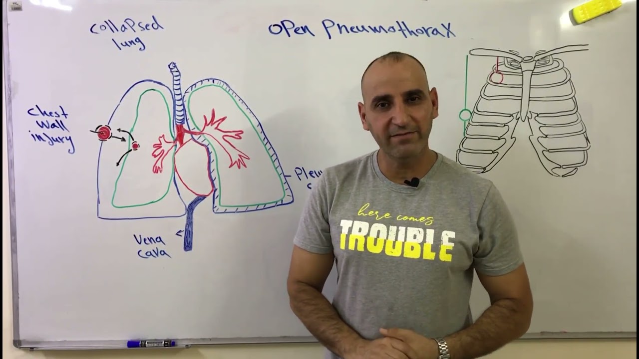 اصابات الصدر المفتوح(استرواح الصدر المفتوح) Open pneumothorax