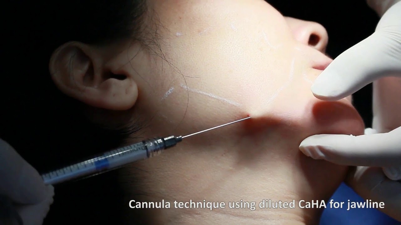 Hyperdilution of CaHA fillers &ndash; Video abstract [ID 159752]