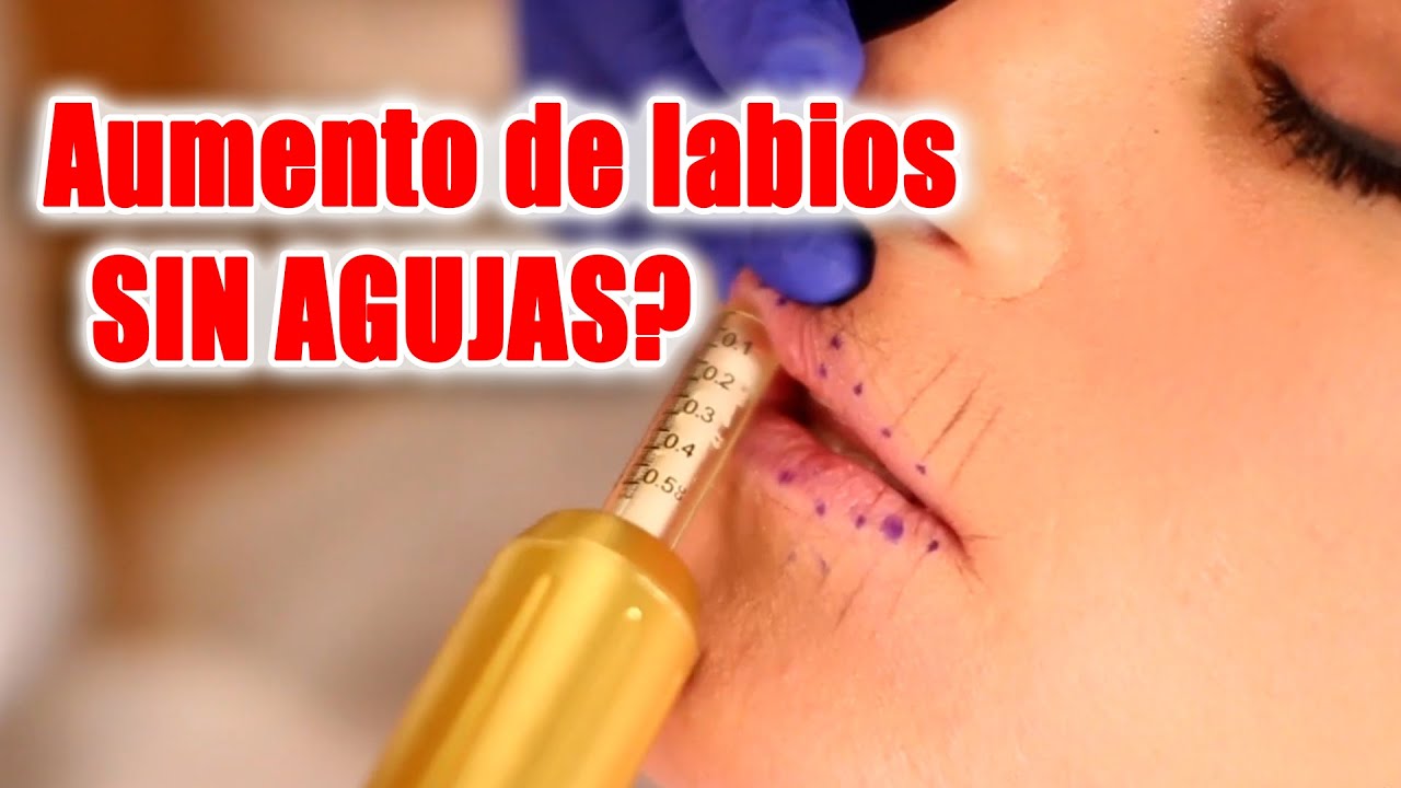 💋 ACIDO HIALURONICO para AUMENTO DE LABIOS SIN AGUJAS? 2021💋  HYALURON PEN, La mejor alternativa 🔥