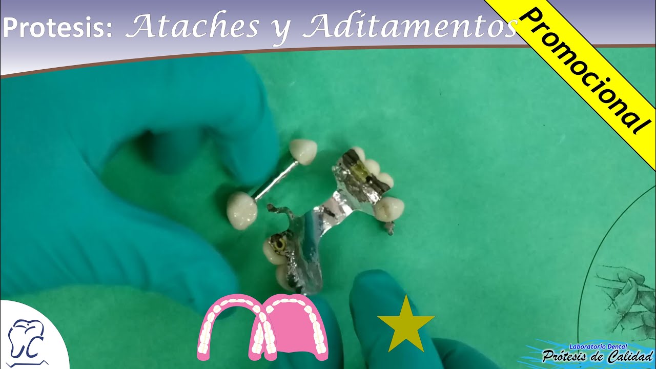 Pr&oacute;tesis: Ataches y Aditamentos 05