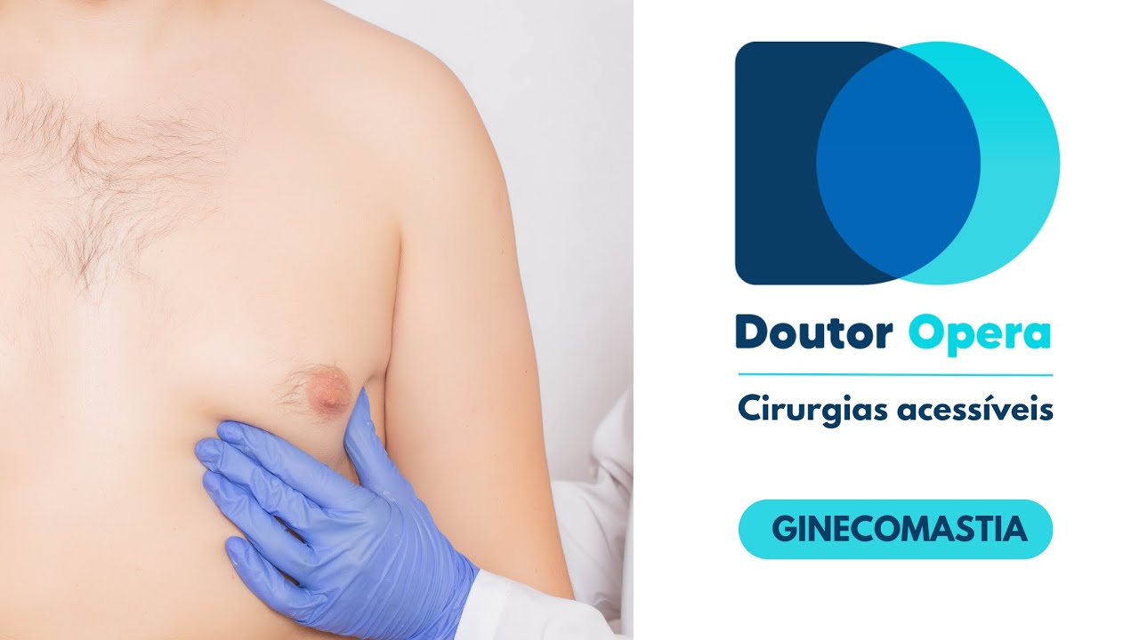 Ginecomastia - Cirurgia de retirada de glândula mamária masculina