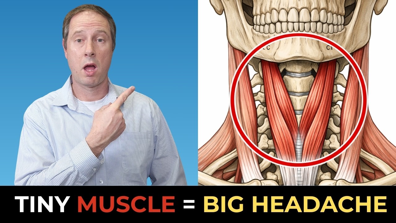Крошечная мышца шеи, вызывающая цервикогенные головные боли и головокружение (большинство людей э...