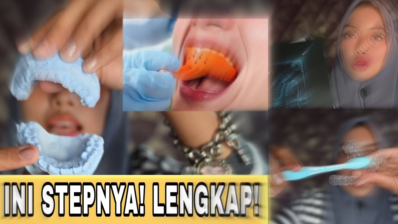 BIAYA & PROSEDUR PASANG BEHEL SAMPAI LEPAS BEHEL LENGKAP! + TIPS ❗️