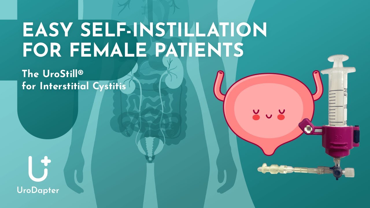 Easy Self-Instillation for Female Patients: The UroStill® for Interstitial Cystitis